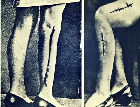 The deformed legs of the Ravensbruck "rabbits", the women who were subjected to the medical experimentation of the camp's medical team.