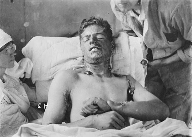 A Canadian soldier being treated for gas burns during WWI