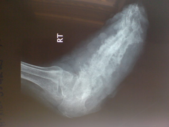 Madura Foot X-Ray. Photo Credit.