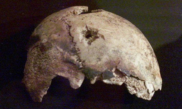 The mysterious skull fragment, which Russian officials believe belongs to Hitler