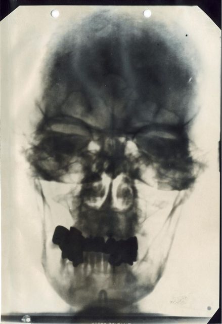 X-ray of Hitler’s head