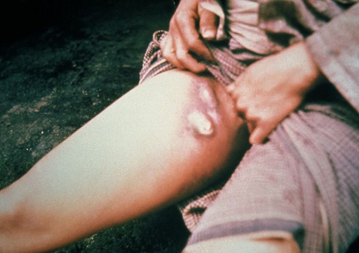 A bubo on the upper thigh of a person infected with bubonic plague.