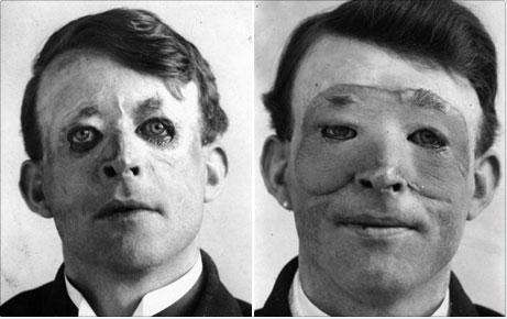 Walter Yeo, a sailor injured at the Battle of Jutland, is assumed to be the first person to receive plastic surgery in 1917. The photograph shows him before (left) and after (right) receiving a flap surgery performed by Gillies.