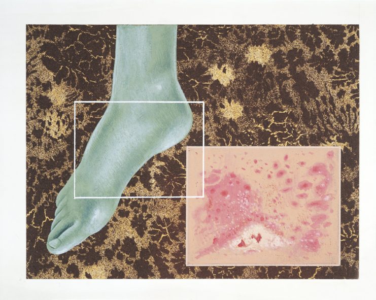 Illustration showing the effects of athlete's foot