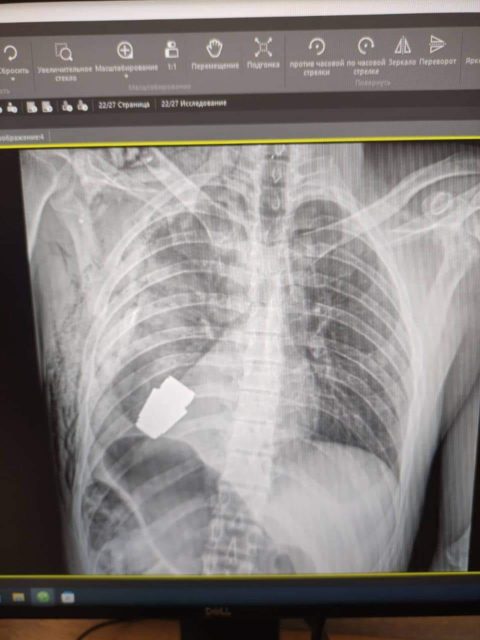 X-ray of a live grenade in the chest of a Ukrainian soldier